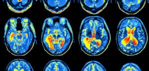 Can a Brain Scan Help Diagnose ADHD? • American Health Imaging