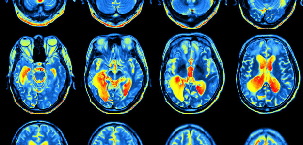 mri brain scan