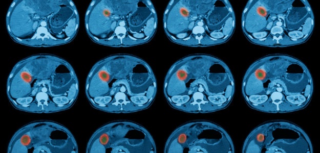 How Long Does Ct Scan Results Take Infrared For Health