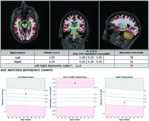 Neurowquant Understanding NeuroQuant • American Health Imaging