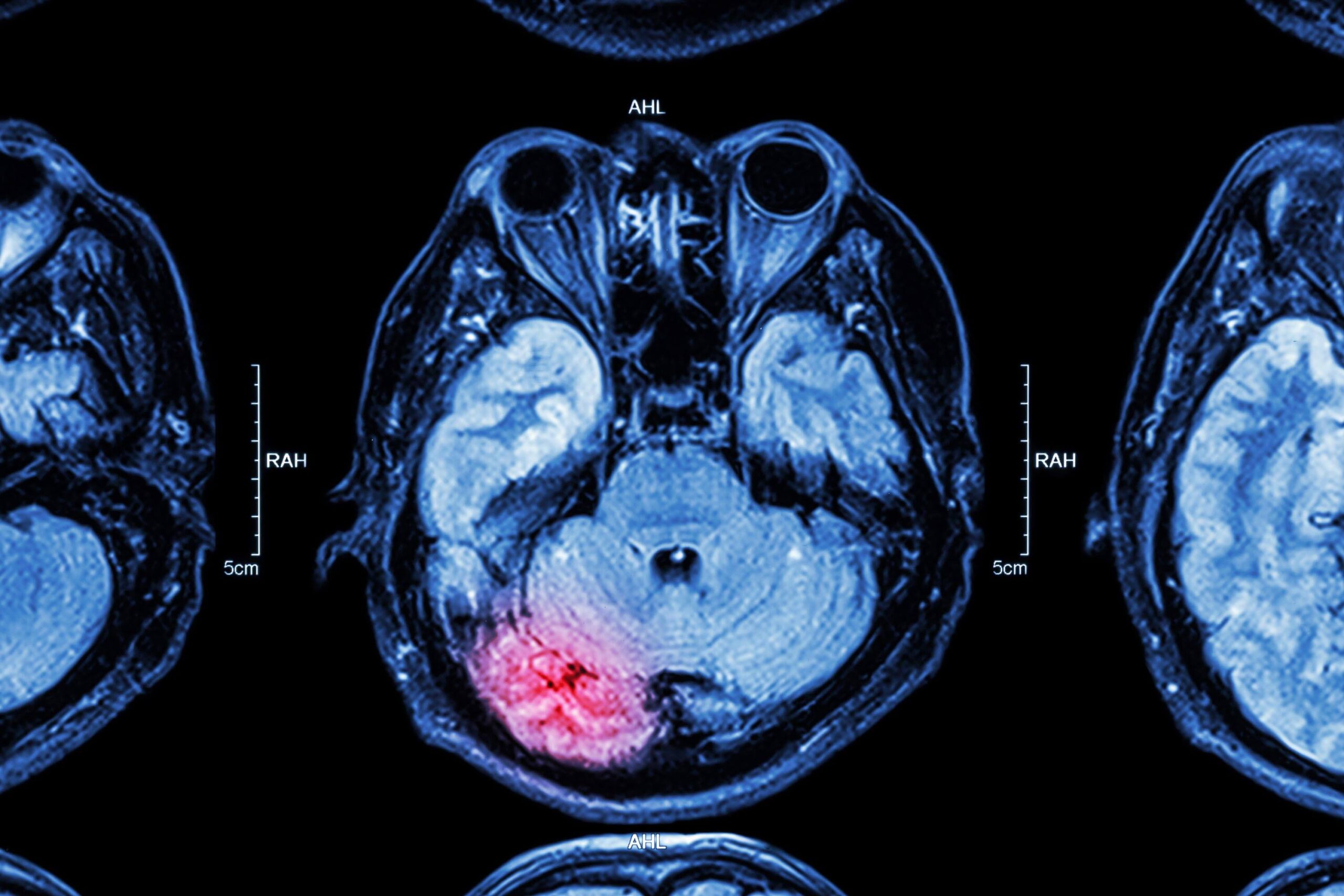 Traumatic Brain Injury • American Health Imaging