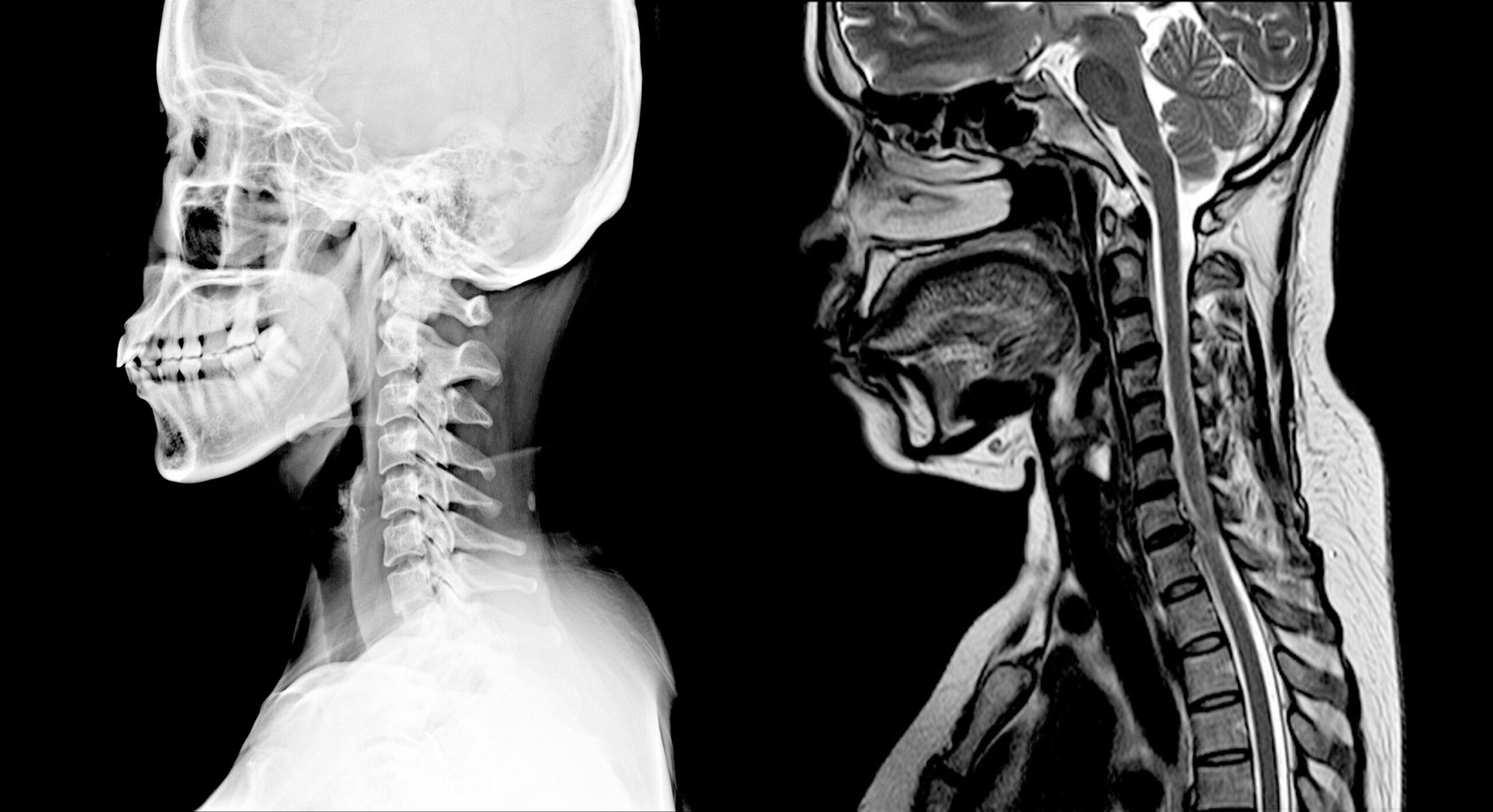 Coronal Mri Cervical Spine At Betty Sudduth Blog